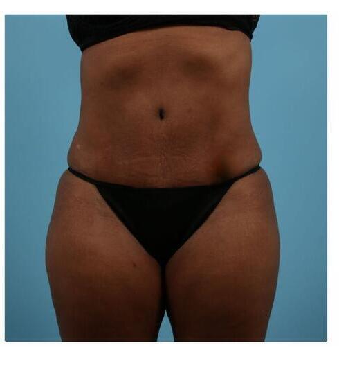 Abdominoplasty Before & After Image