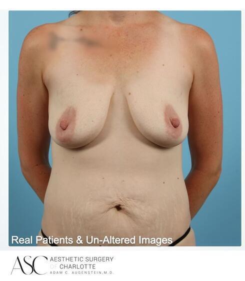 Abdominoplasty Before & After Image