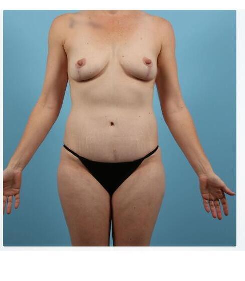 Abdominoplasty Before & After Image