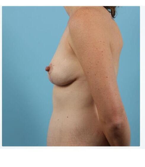 Abdominoplasty Before & After Image