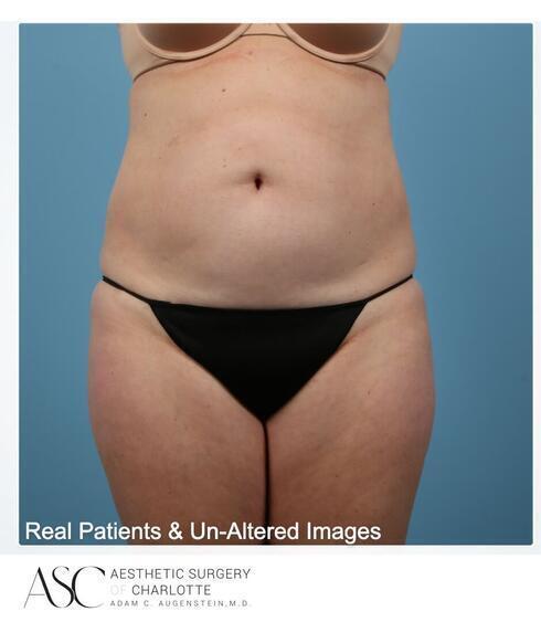 Abdominoplasty Before & After Image