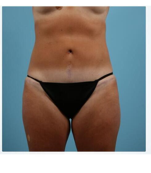 Abdominoplasty Before & After Image