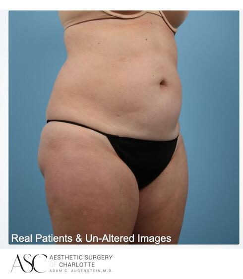 Abdominoplasty Before & After Image