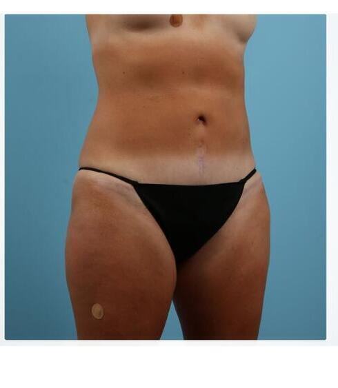 Abdominoplasty Before & After Image