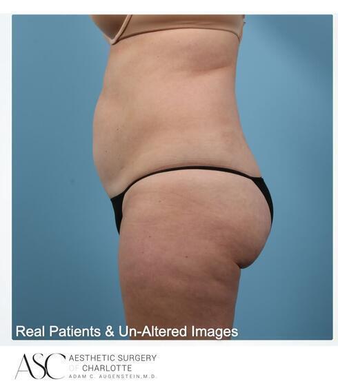 Abdominoplasty Before & After Image