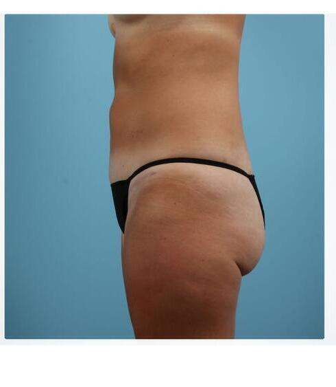 Abdominoplasty Before & After Image