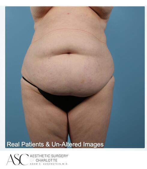 Abdominoplasty Before & After Image