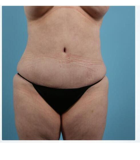 Abdominoplasty Before & After Image