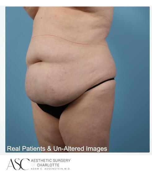 Abdominoplasty Before & After Image