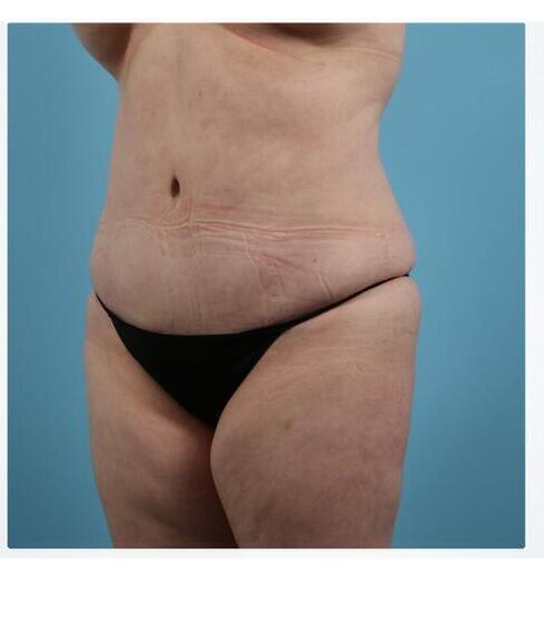 Abdominoplasty Before & After Image