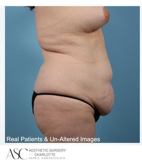 Abdominoplasty Before & After Image