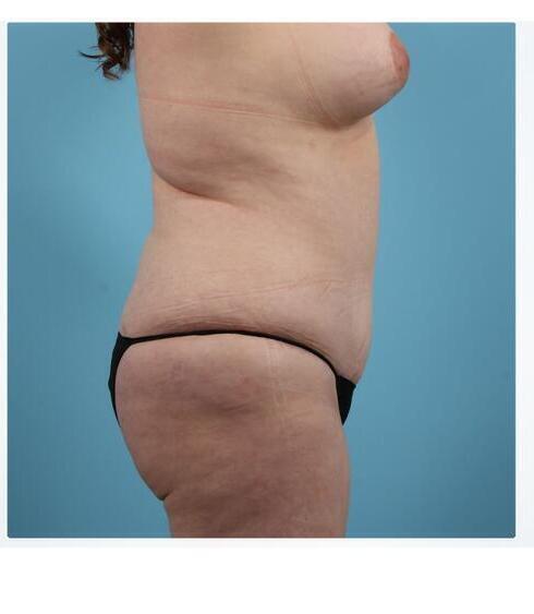 Abdominoplasty Before & After Image