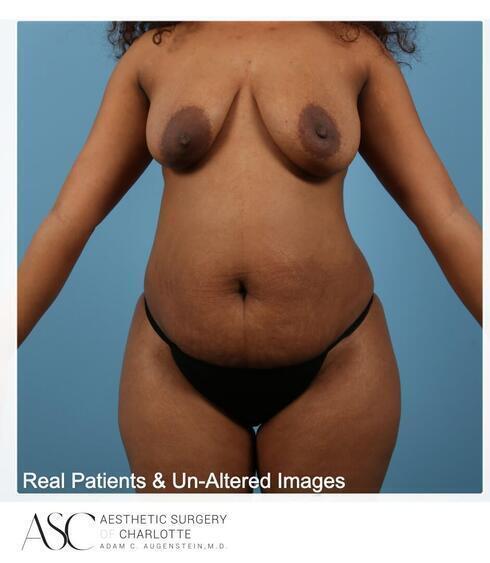 Abdominoplasty Before & After Image