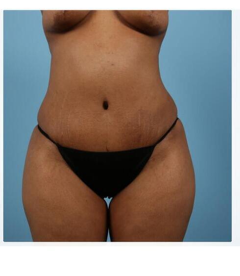 Abdominoplasty Before & After Image