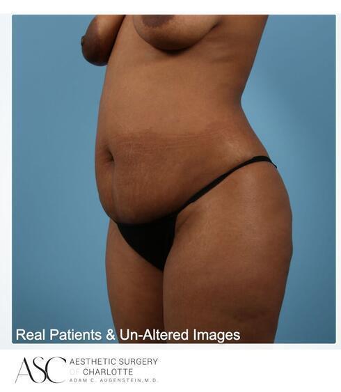 Abdominoplasty Before & After Image