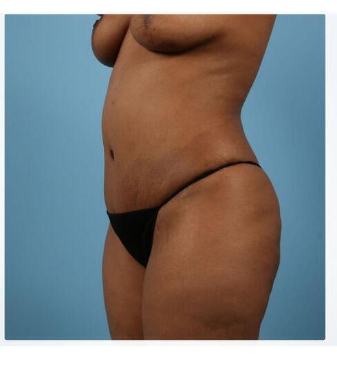 Abdominoplasty Before & After Image