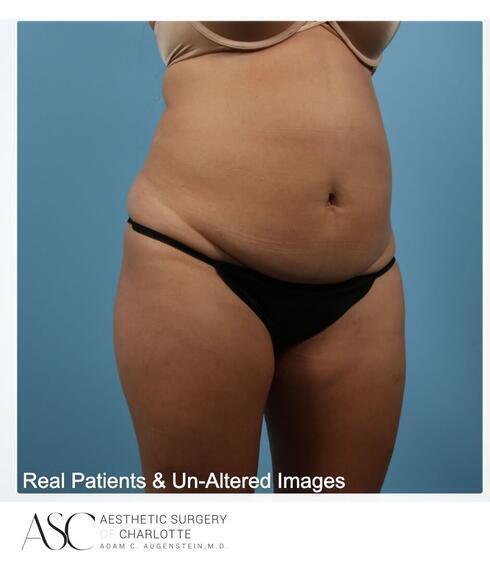 Abdominoplasty Before & After Image