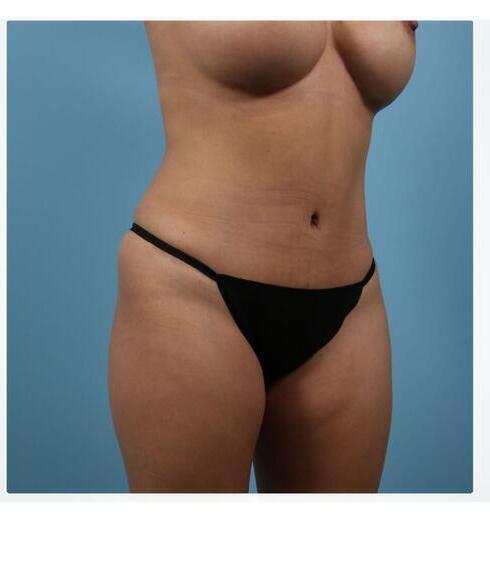 Abdominoplasty Before & After Image