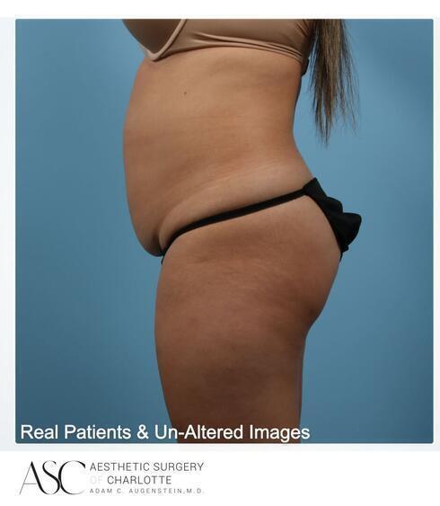 Abdominoplasty Before & After Image