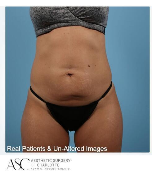 Abdominoplasty Before & After Image