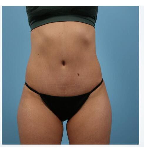 Abdominoplasty Before & After Image