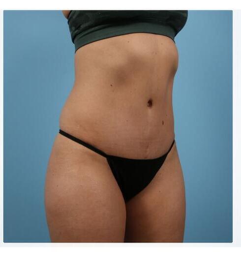 Abdominoplasty Before & After Image