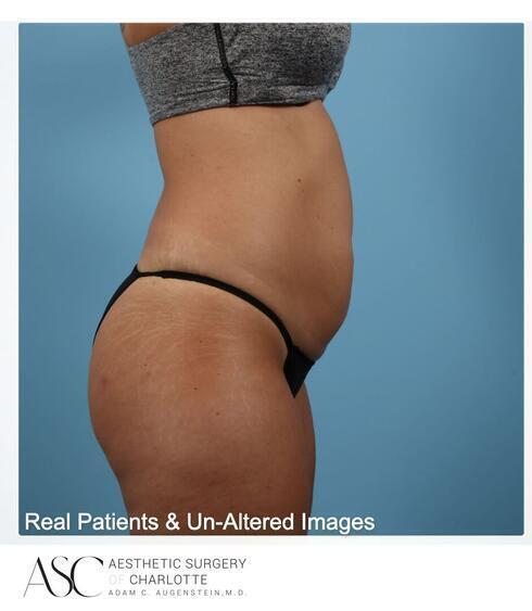 Abdominoplasty Before & After Image