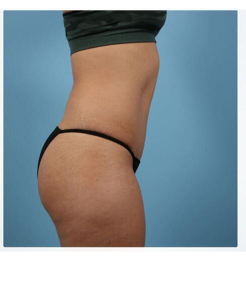 Abdominoplasty Before & After Image