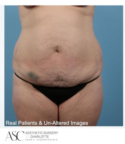 Abdominoplasty Before & After Image