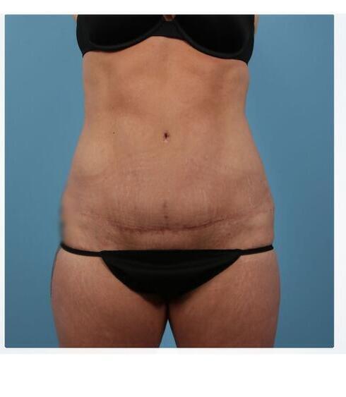 Abdominoplasty Before & After Image