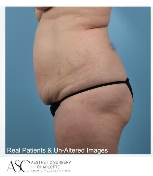 Abdominoplasty Before & After Image