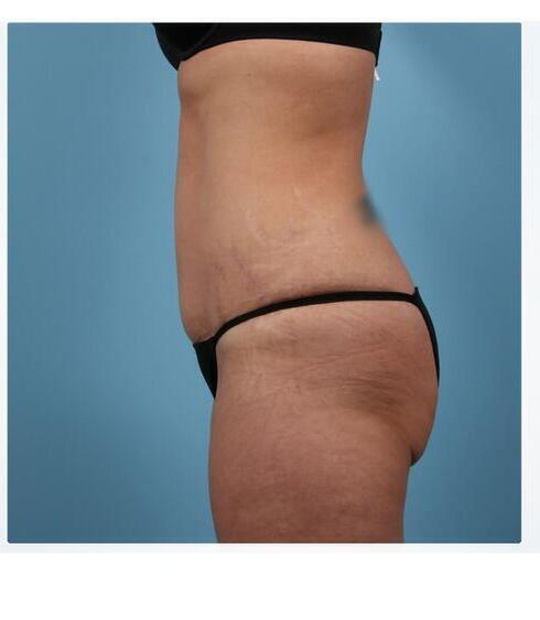 Abdominoplasty Before & After Image