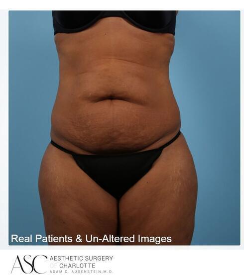 Abdominoplasty Before & After Image