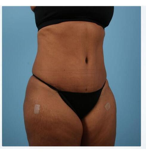 Abdominoplasty Before & After Image