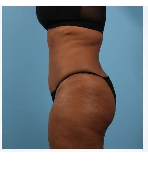 Abdominoplasty Before & After Image