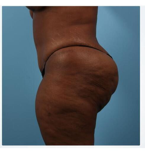 Abdominoplasty Before & After Image