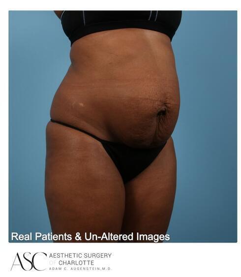 Abdominoplasty Before & After Image