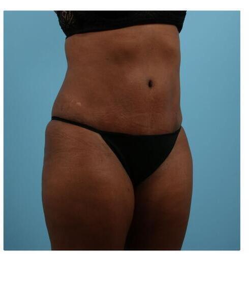 Abdominoplasty Before & After Image