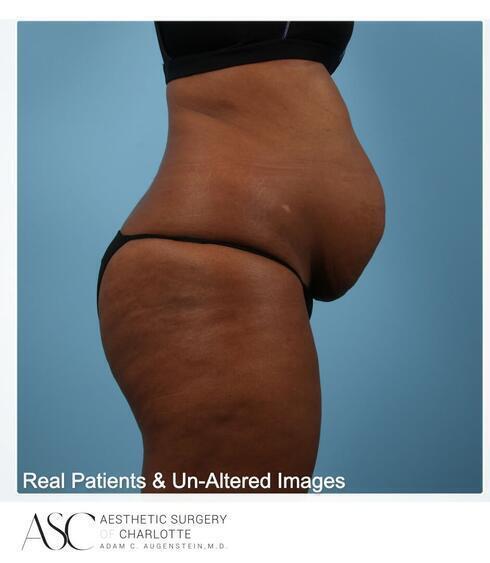 Abdominoplasty Before & After Image