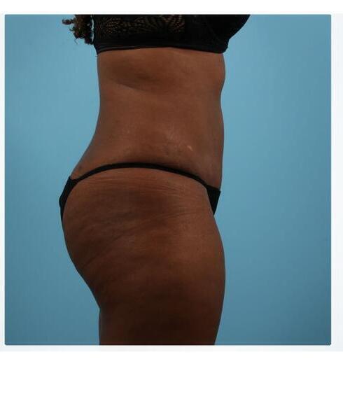 Abdominoplasty Before & After Image