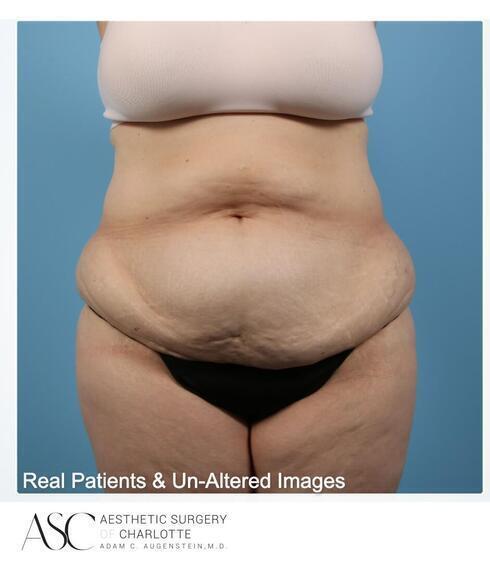 Abdominoplasty Before & After Image