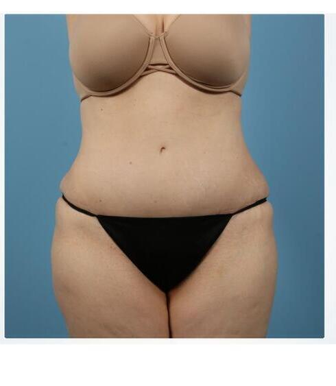 Abdominoplasty Before & After Image