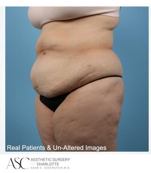 Abdominoplasty Before & After Image