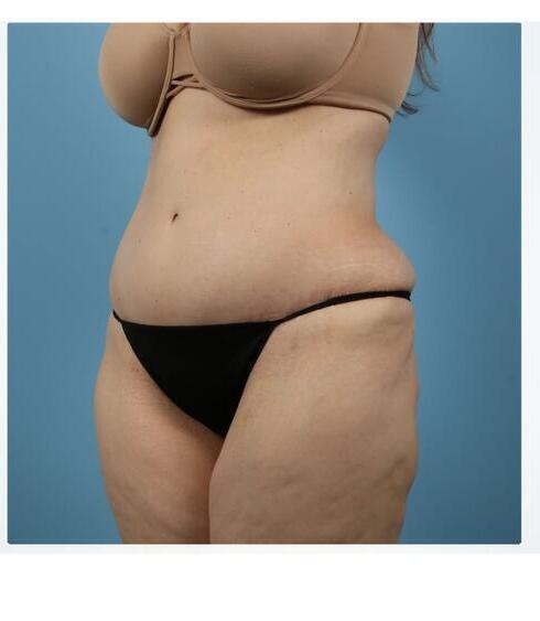 Abdominoplasty Before & After Image