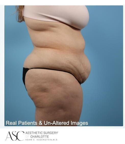 Abdominoplasty Before & After Image