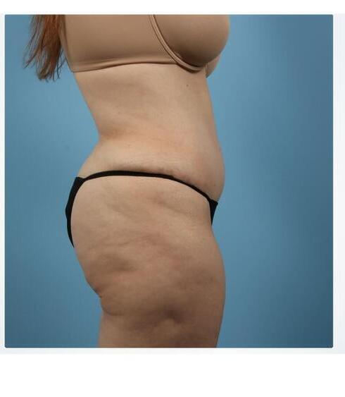 Abdominoplasty Before & After Image