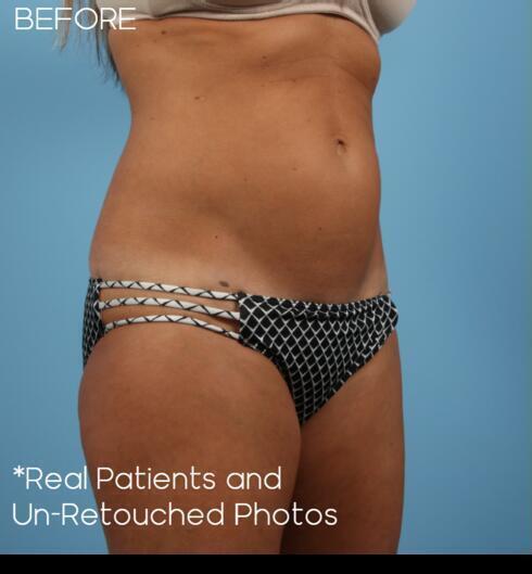 Abdominoplasty Before & After Image