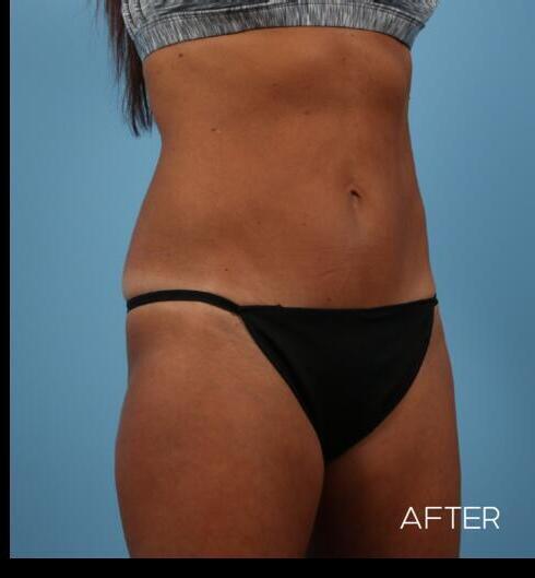 Abdominoplasty Before & After Image