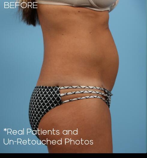 Abdominoplasty Before & After Image