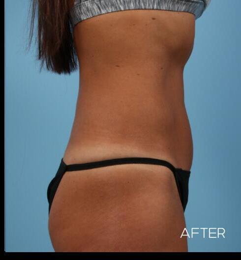 Abdominoplasty Before & After Image